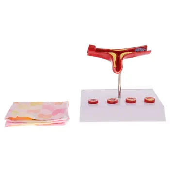 

50x Magnification Cross Sectional Atherosclerosis Model Human Vessel Anatomical Model for School Teaching Tool Learning Display