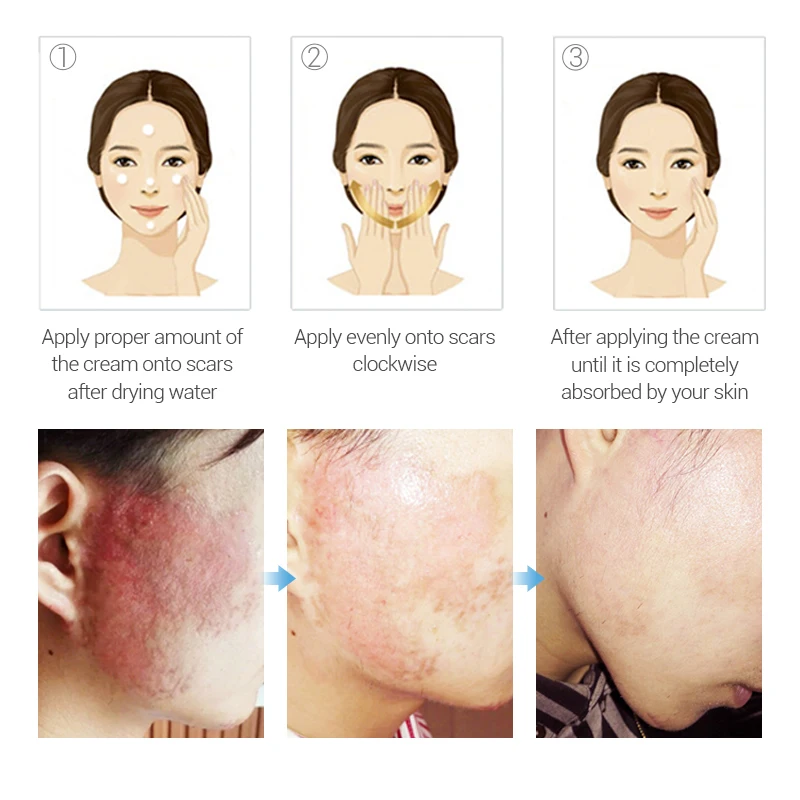 Buy 3 Get 1 Gift Lanbena Egf Remover Scar Cream Stretch Mark Gel Anti Acne Cream 3pcs +skin Repair Face Cream Acne Treatment