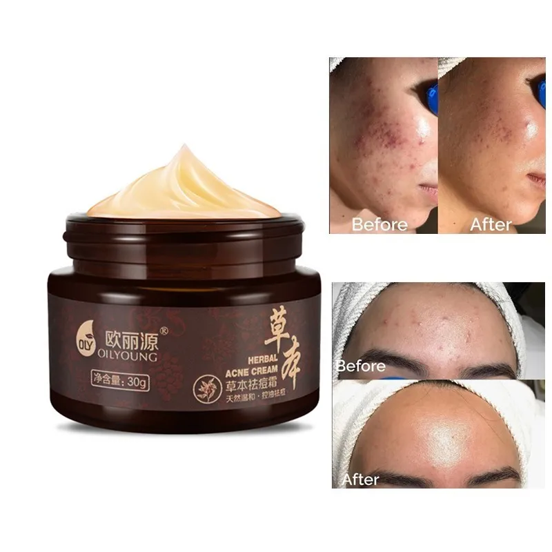 Herbal Acne Cream 30g Anti Pimple Spot Scars Blackhead Removal Whitening Skin Face Care Treatment DropShip|Автозагары и