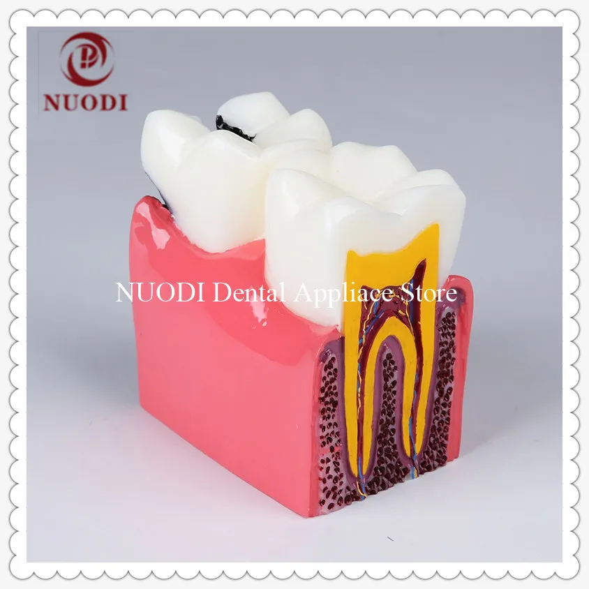 

6Ttimes Caries Comparation tooth model/Caries Model for Dentist/Dental Lab teeth model Compares the health and caries tooth