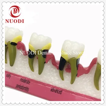 

Dentist Periodontal Diseas teeth Model showing occlusal trauma/ Periodontal Disease Dental Teeth Model/Dental Study Model