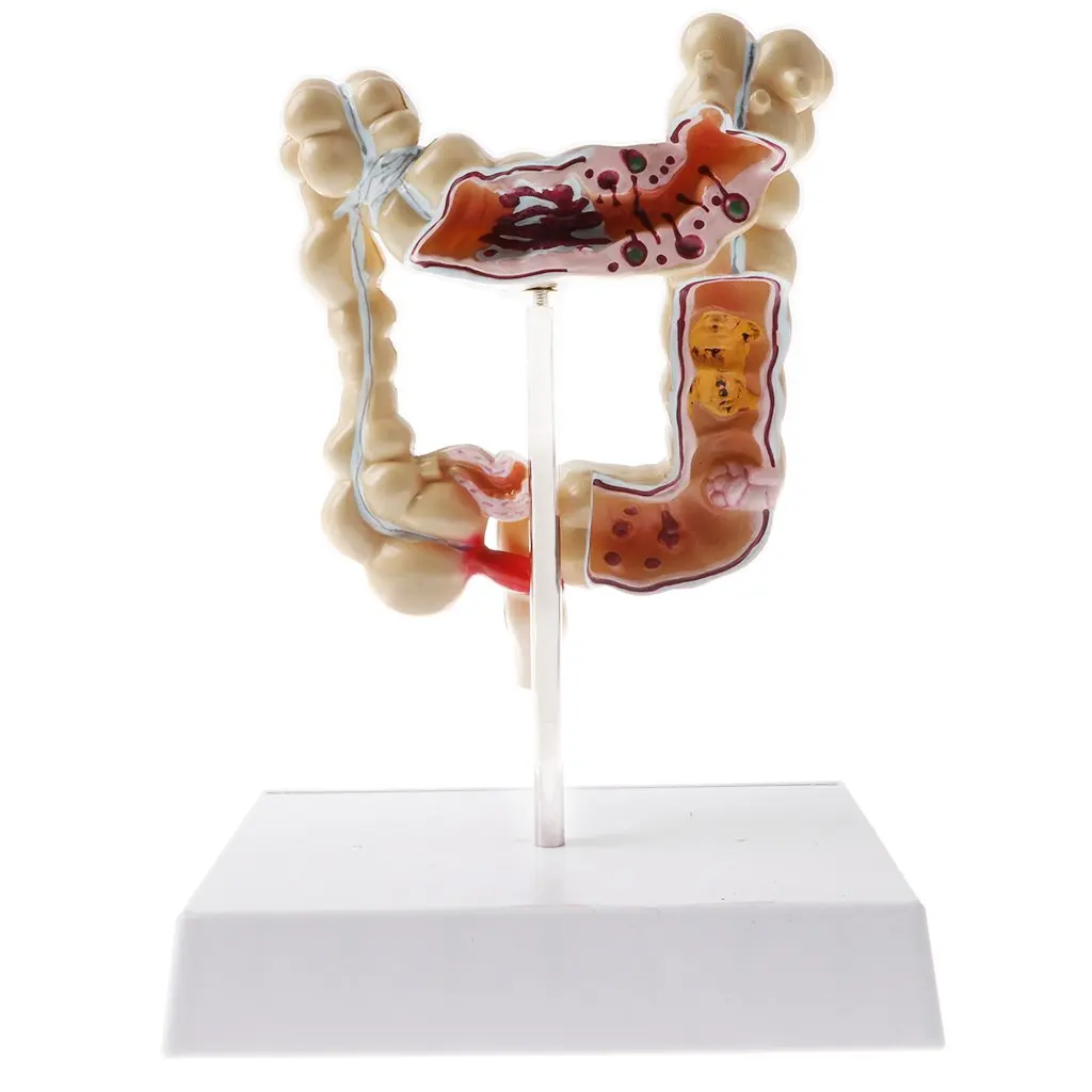  1: 2 Human Large Bowel Pathological Model Medical Anatomical Model for School Teaching Tool Learnin - 32973576715