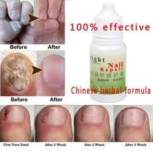 Действительно работает убивает грибок ногтей грибок лечение крем онихомикоз параоникция противогрибковые инфекция ногтей 10 мл