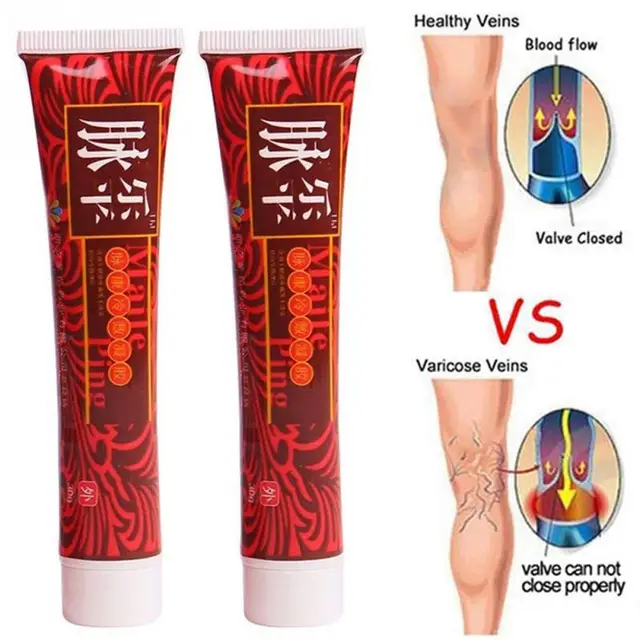 varicose veins treatment cream