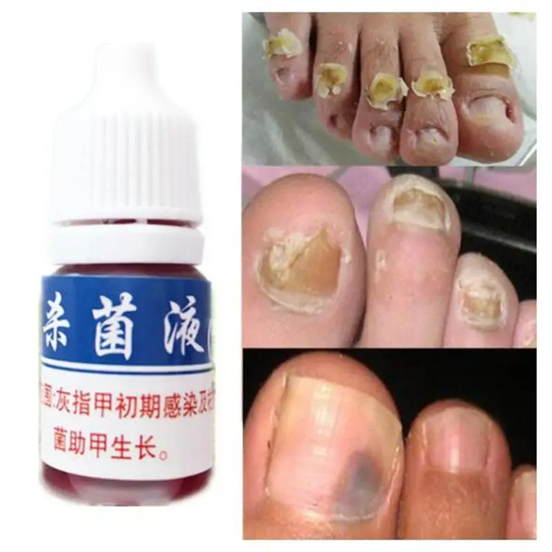 

XY Fancy Chinese Herbal Nail Antifungal Treatment Sterilization Liquid Foot Care Nail Repair Treatment Liquid