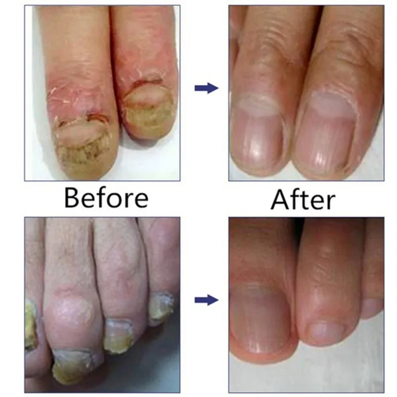 10 мл Лечение ногтей от грибка эссенция для ногтей Отбеливание ног удаление грибка Уход за ногами и ногтями гель для Onychomycosis