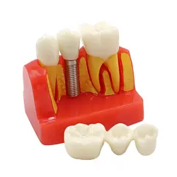 1 ПК Dental Implant Зубы Модель 4/четыре раза средство для полировки зубов кварцевый резиновый зубы Денто-модель для преподавания, тренировки