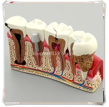

Pathologies teeth Model M4029 /Doctor-patient communication teeth model/Dental Caries tooth model
