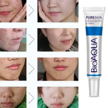

30g Anti Acne Cream Oil Control Shrink Pores Treatment Cream Acne Scar Remove Skin Care #0110
