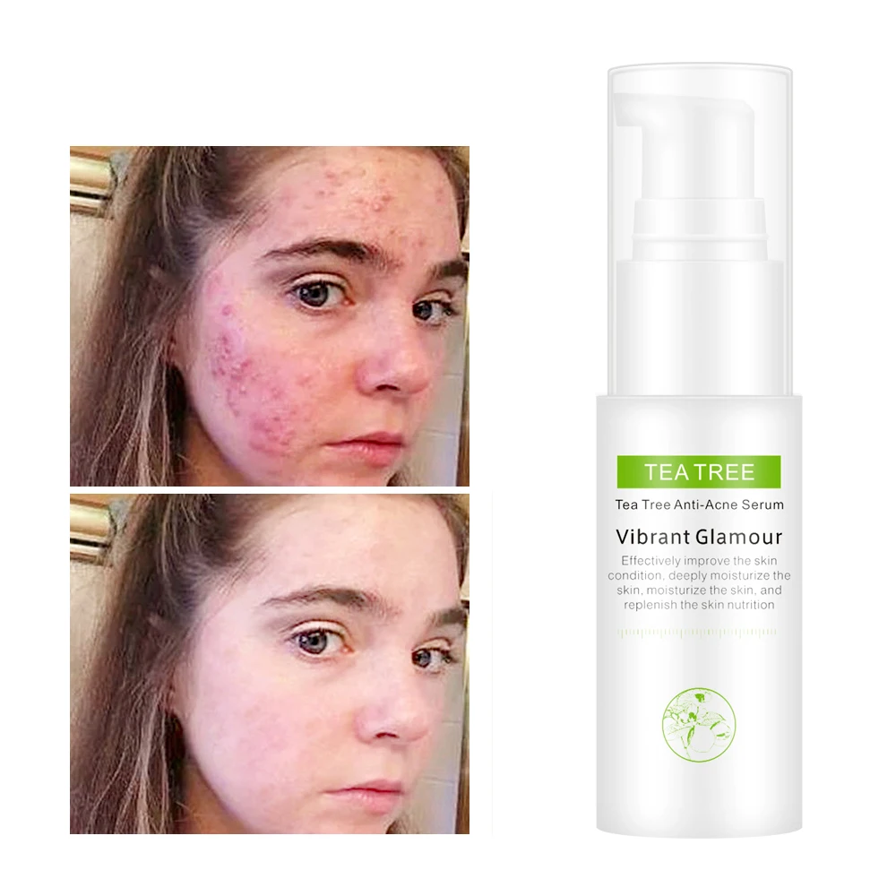 

VG-MB013 Tea Tree Essence Raw Skin Care Removing Acne Repairing Acnes Printing Control Oil Refreshing Water Refreshing Toner