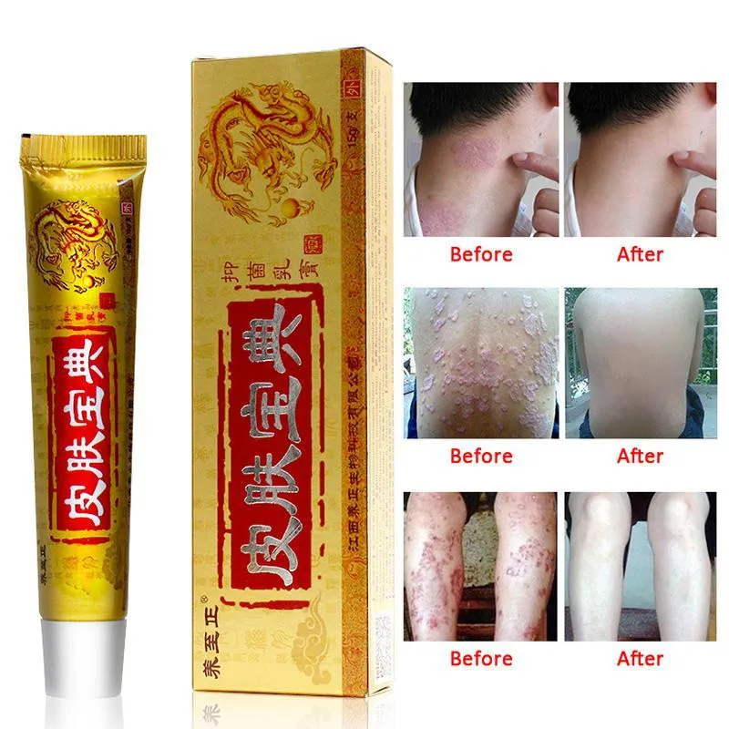 

Rakado 1PC Powerful Original Psoriasis Dermatitis Eczema Pruritus Skin Problems Cream With Retail Box Skin Care Plaster Tool New