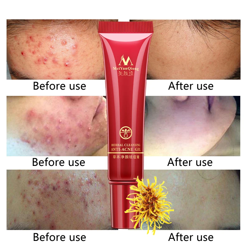 pimple cream for oily skin