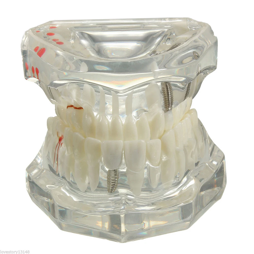 

Dental Implant Disease Teeth Model For Medical Science Dental Disease Teaching Study With Restoration Bridge Tooth Dentist