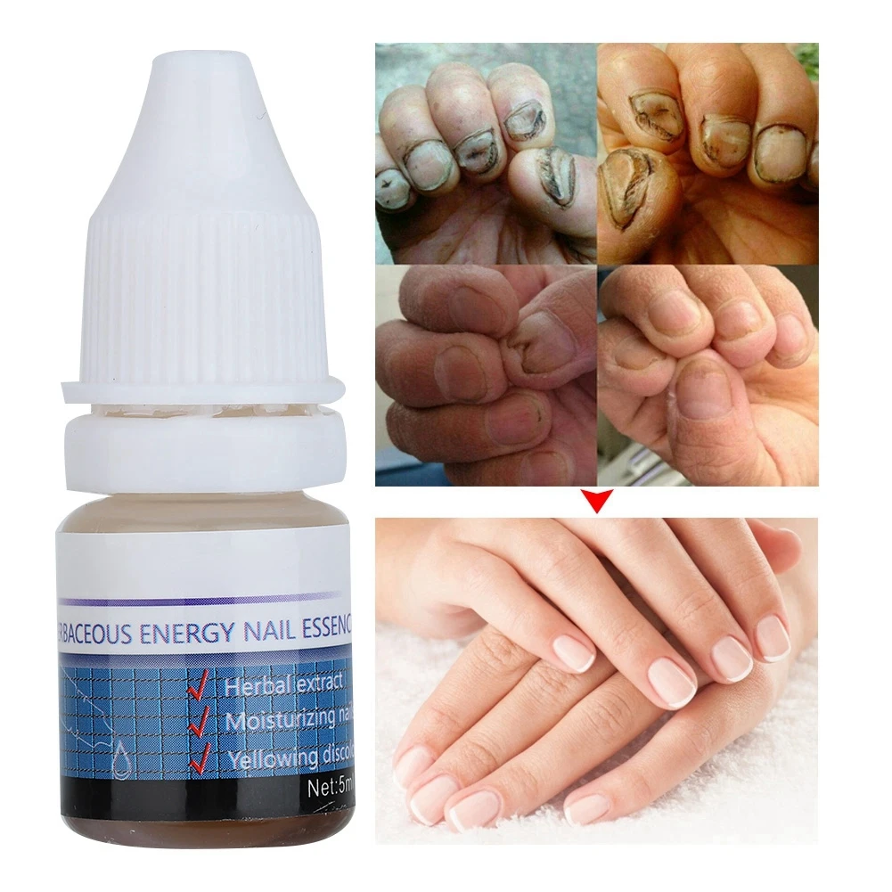 

5ml Leuconychia Treatment Powerful Anti-fungus Herbal Plants Extract Nail Care Solution Manicure Repair Gel Essence Tool