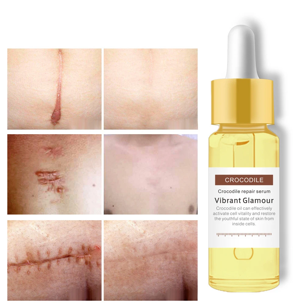 

15 ml Remove Scar Cream Remove Acne Spots Remove Striae Gravidarum Pigmentation Corrector AntiAging Lighten Acne print