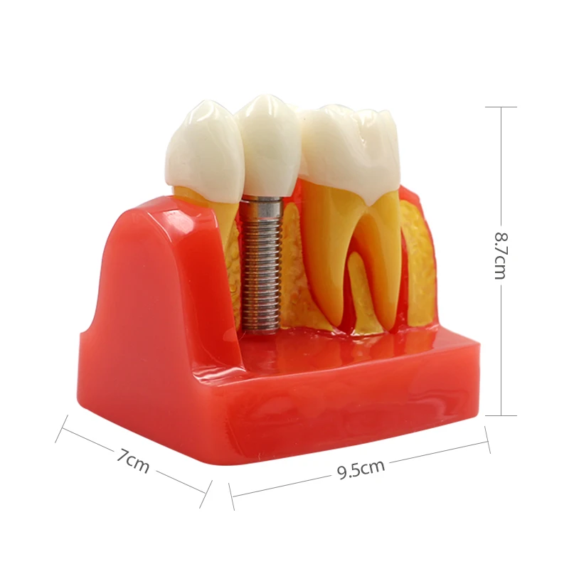  Dental Teach Implant Analysis Crown Bridge Removable Model Dental Teeth Model Teaching study Dentis - 33007211978
