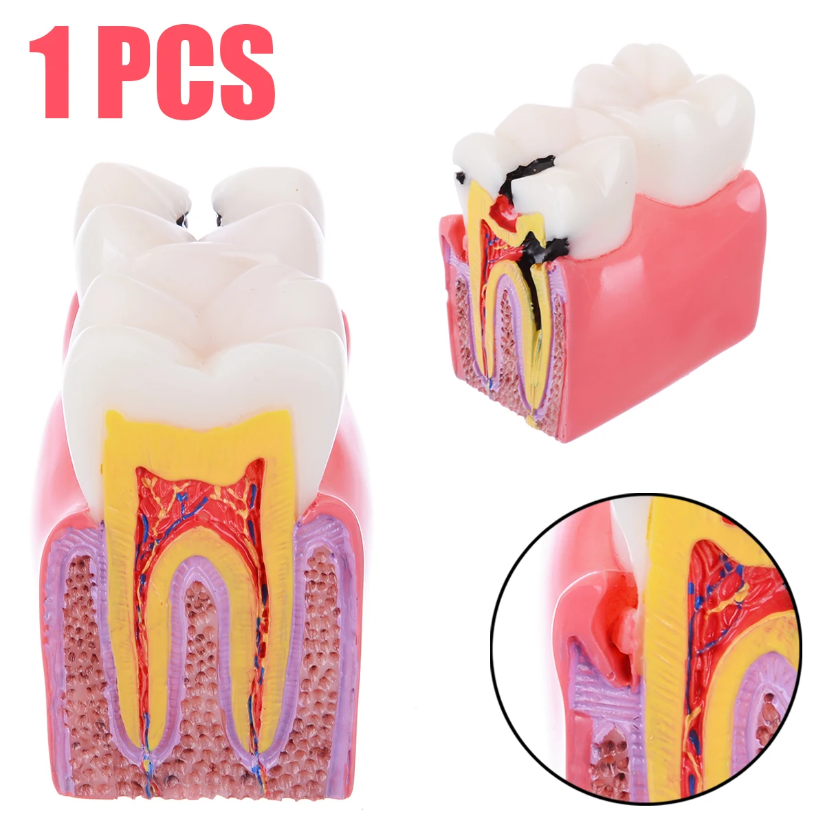

1pc 6X Decay Denture Teeth Model Dentist Pathologies Caries Comparison Tooth Model for Medical Science Dental Teaching Study