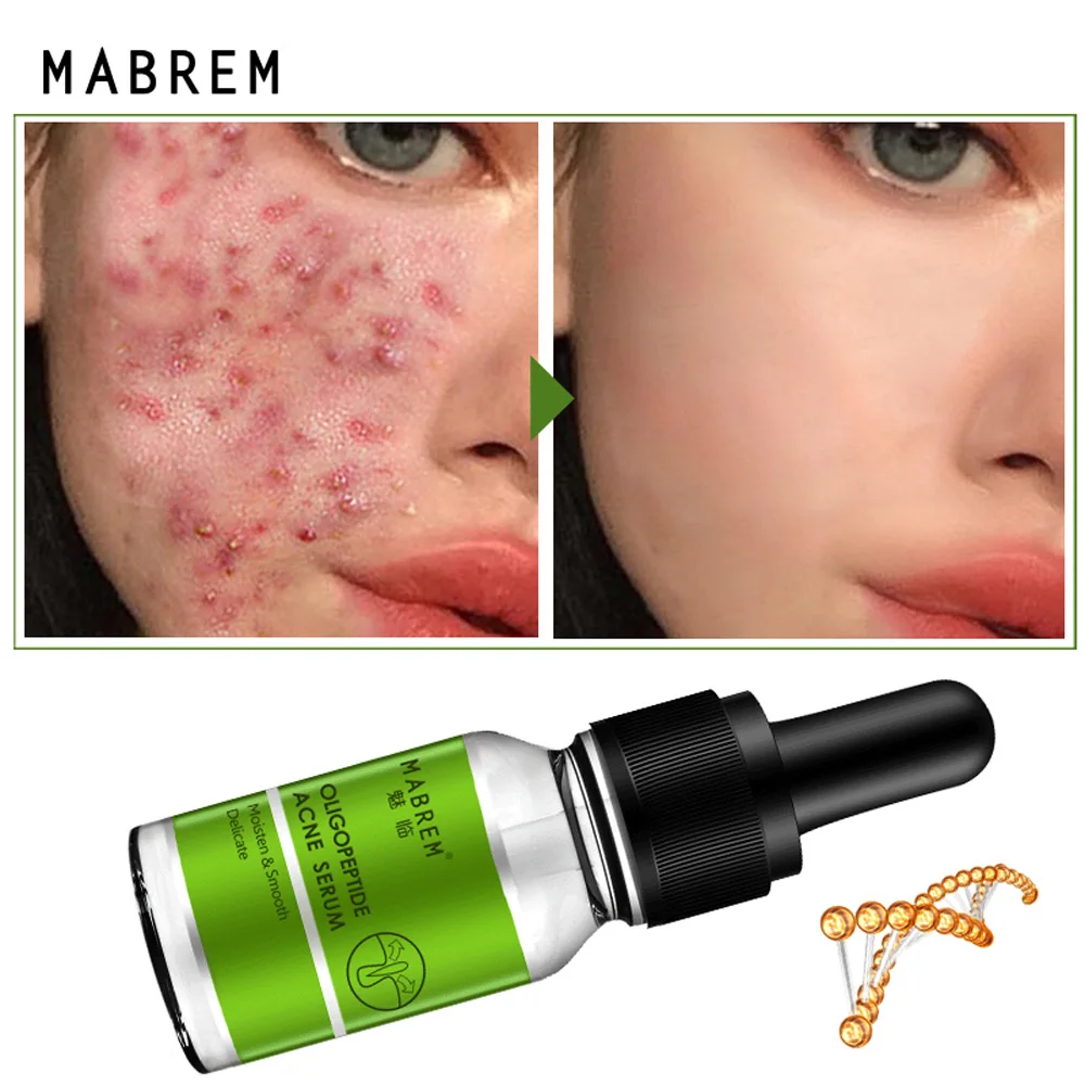 

MABREM Skin Care 10ML Oligopeptide Acne Cleaning Lotion Serum Acne Treatment Cream Pore Repair Whitening Moisturizing Essence