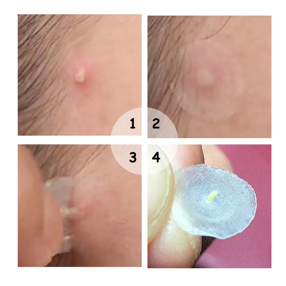 Breylee Acne Pimple Patch Acne Treatment Stickers Pimple Remover Tool Blemish Spot Skin Care Facial Mask Waterproof Night Use Breylee Acne Pimple Patch Acne Treatment Stickers Pimple Remover Tool Blemish Spot Skin Care Facial Mask Waterproof Night Use