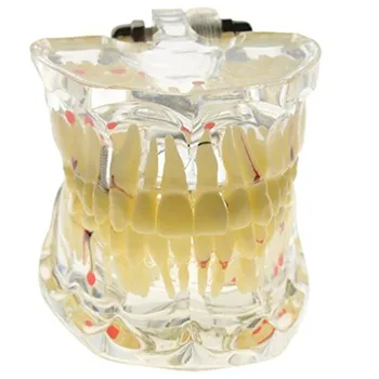 

Dental Implant Disease Teeth Model Denture Restoration Model Tooth Dentist For Medical Science Dental Disease Teach Study Tool