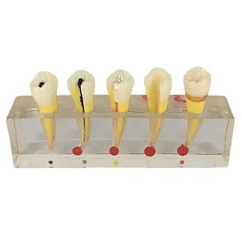 

Root Canal Treatment Steps Teeth Disease Model Human Medical Model for School Teaching Tool Learning Display Lab Supplies