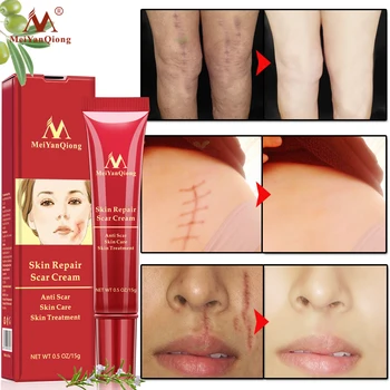 

Acne Scar Removal Cream Skin Repair Face Cream Acne Spots Acne Treatment Blackhead Whitening Cream Anti Scar Stretch Marks 15g
