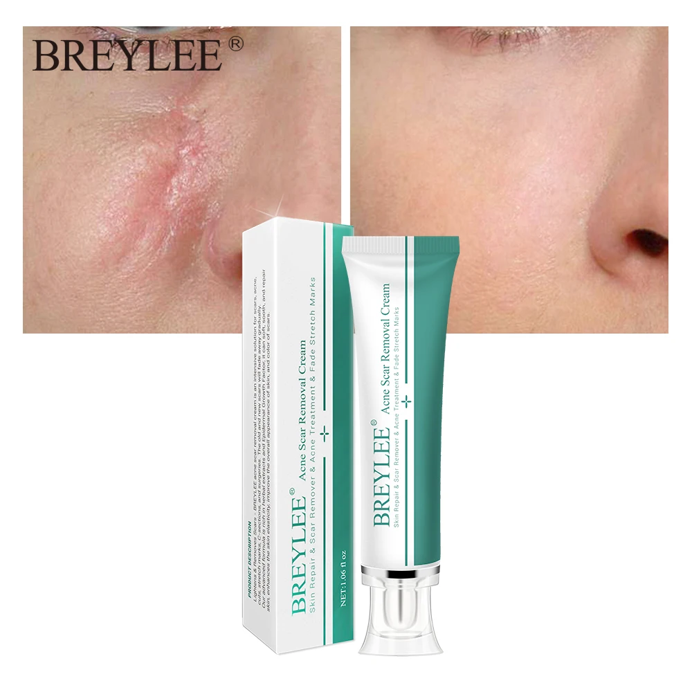 Breylee 3pcs Acne Scar Removal Cream Face Cream Skin Repair Skin Care Scar Acne Treatment Remove Stretch Marks Whitening Cream