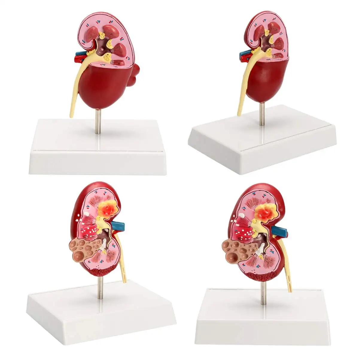 

20x18x14cm Medical Kidney Anatomical Model School Educational Medical Science 2-sided Diseased Anatomy Teaching Learning Model