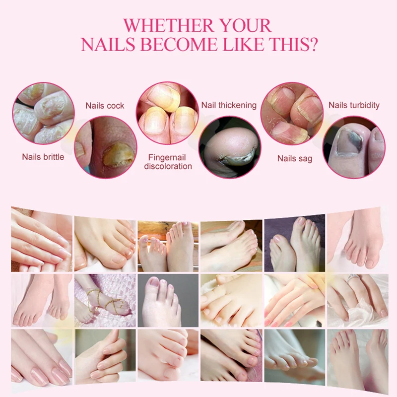 Herbal Nail Treatment Onychomycosis Paronychia Anti Fungal Nail Infection Good Result Chinese Herbal Toe Nail Fungus 5