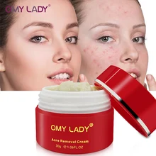 OMY LADY 100% Plant Serum Acne Treatment Gel Acne Cleaning Face Cream Blackhead Remover Acne Spots Acne Scars Repair Comedone plant antimicrobials against acne and dandruff associated pathogens