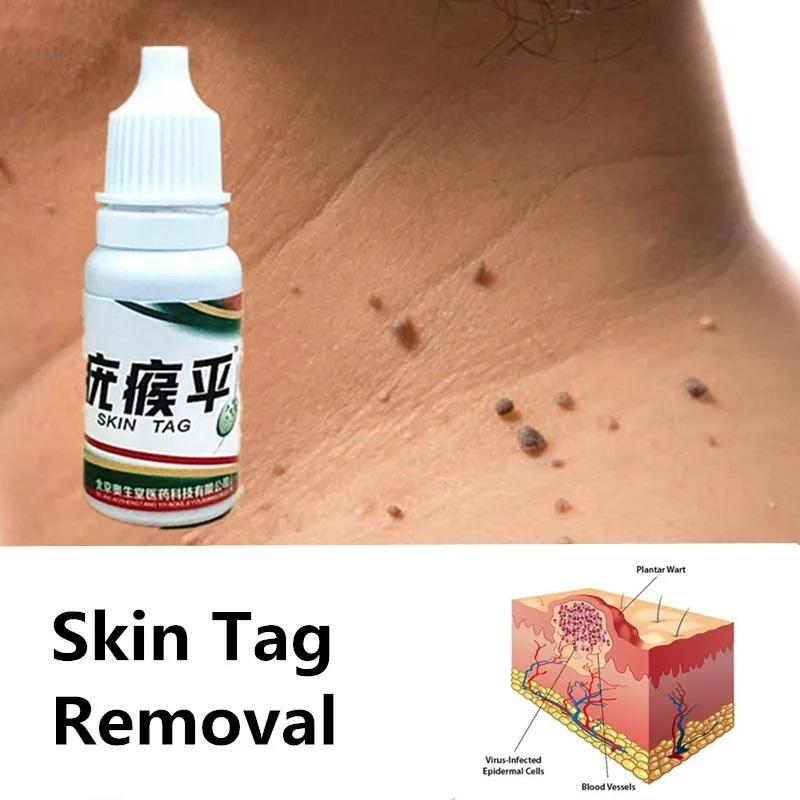 

Ultra Strength Wart Skin Tag Remover 12 hours Medical Tu kill Remover Skin Tag Mole and Genital Wart Remover Dropshipping