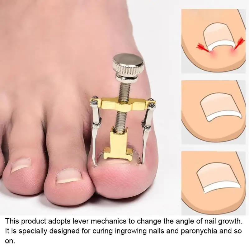 

2pcs/set Ingrown Nail Fixer Pedicure Recover Embed Toenail Correction Lifter Foot Nails Correction Device Recover Clamp Scissors