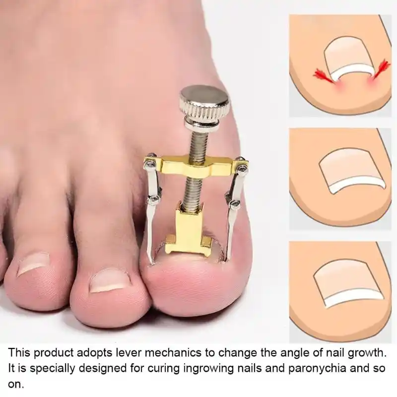 2pcs Set Ingrown Nail Fixer Pedicure Recover Embed Toenail