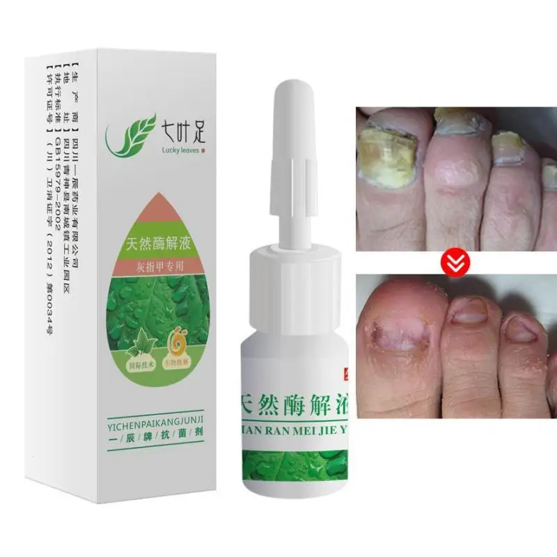 1pc Nail Fungus Treatment Ointment Toe Nail Onychomycosis Paronychia
