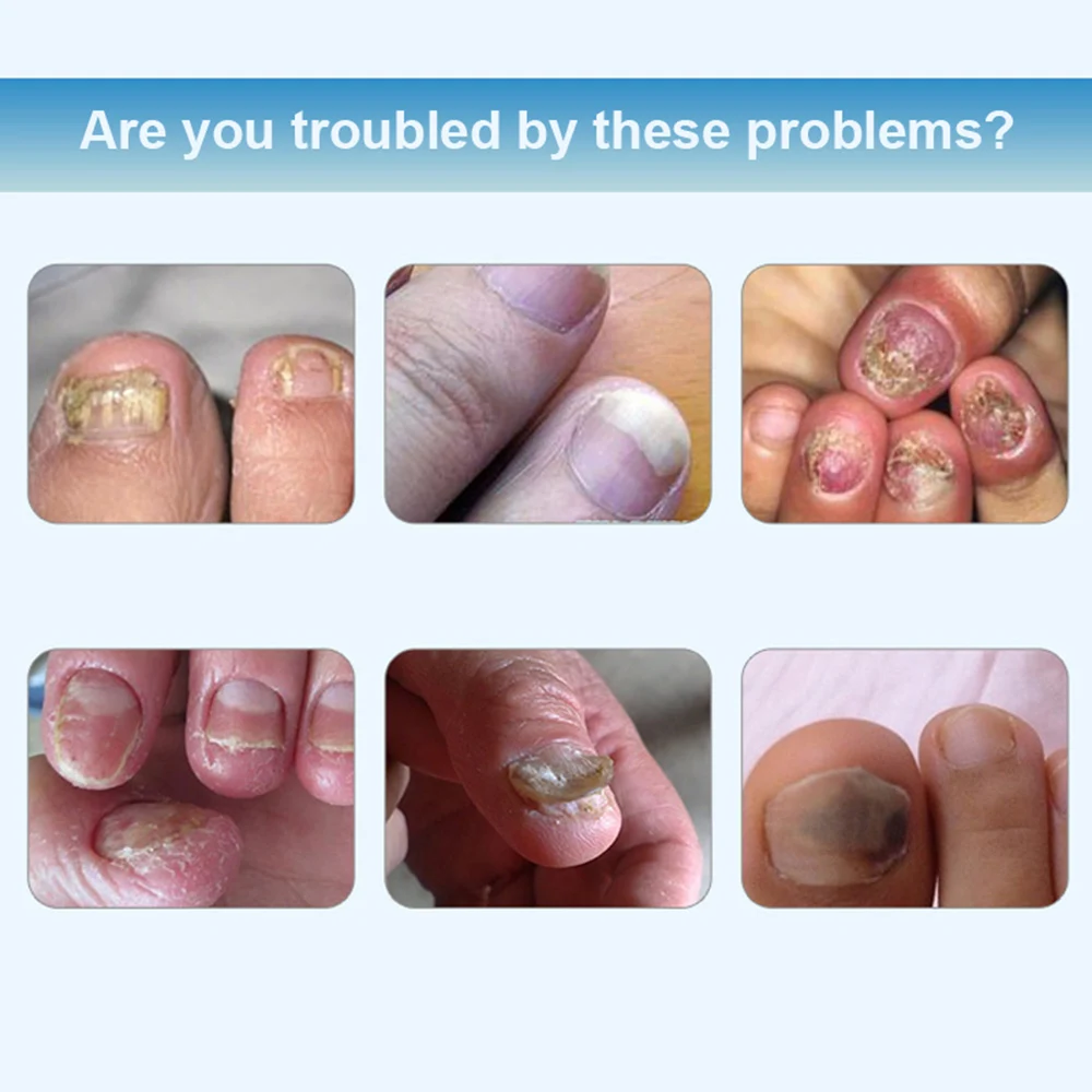 2*10 мл набор для лечения грибка ногтей против грибковой инфекции Безопасный и эффективный уход за ногтями