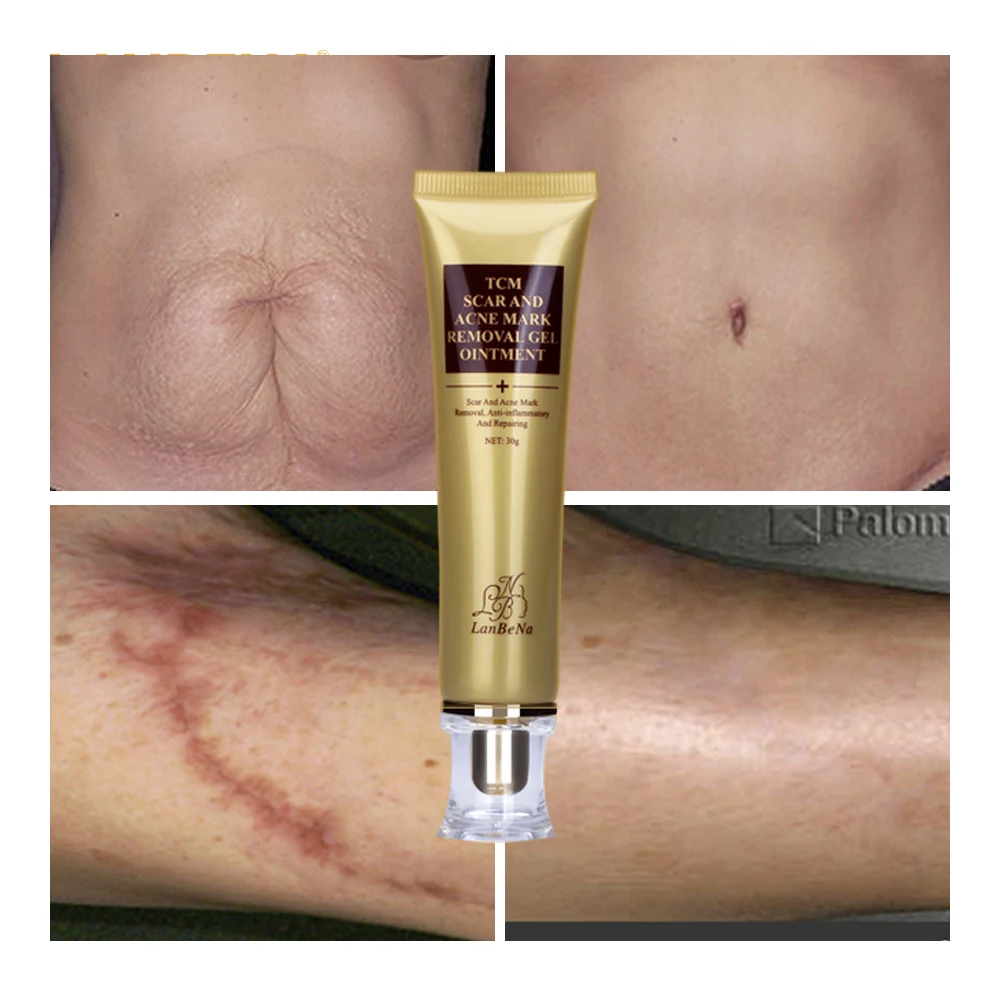 Lanbena Acne Scar Removal Cream Skin Repair Face Cream Acne Spots Acne Treatment Blackhead Whitening Cream Stretch Marks 30ml Lanbena Acne Scar Removal Cream Skin Repair Face Cream Acne Spots Acne Treatment Blackhead Whitening Cream Stretch Marks 30ml