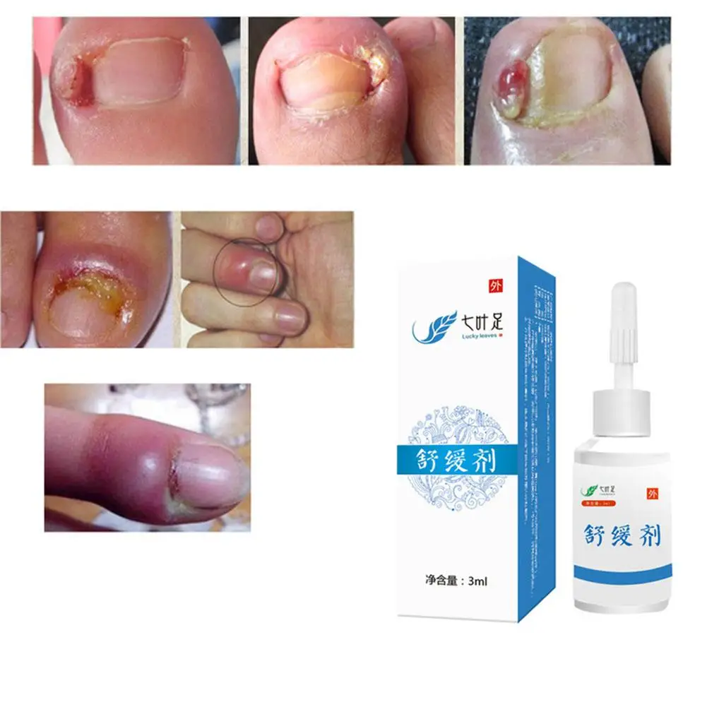 

Liquid Medicine for Paronychia Onychomycosis Nail Fungus Cream Nail Disease Ointment Nails Thickening Hardening Nails Agentia