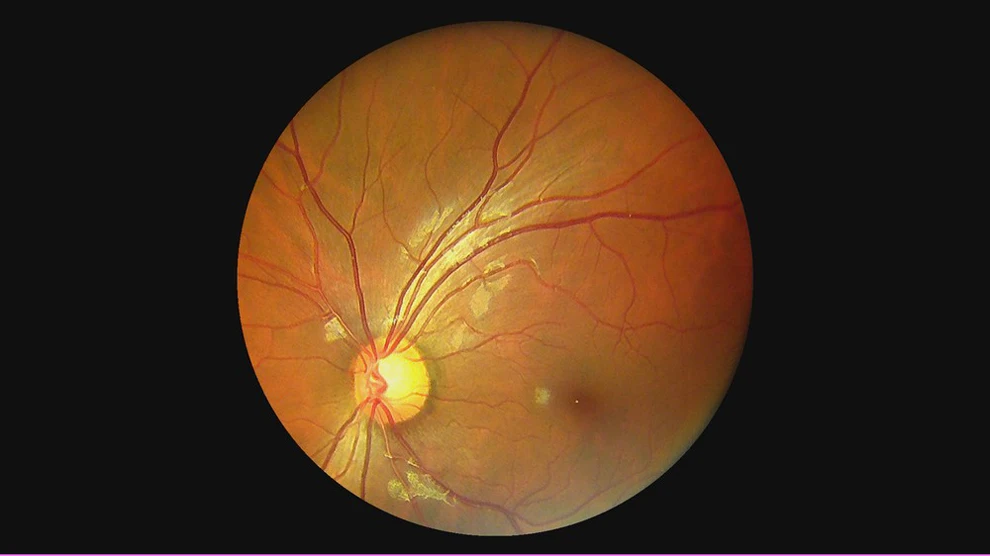  Portable Handheld Fundus Camera With FDA For USA