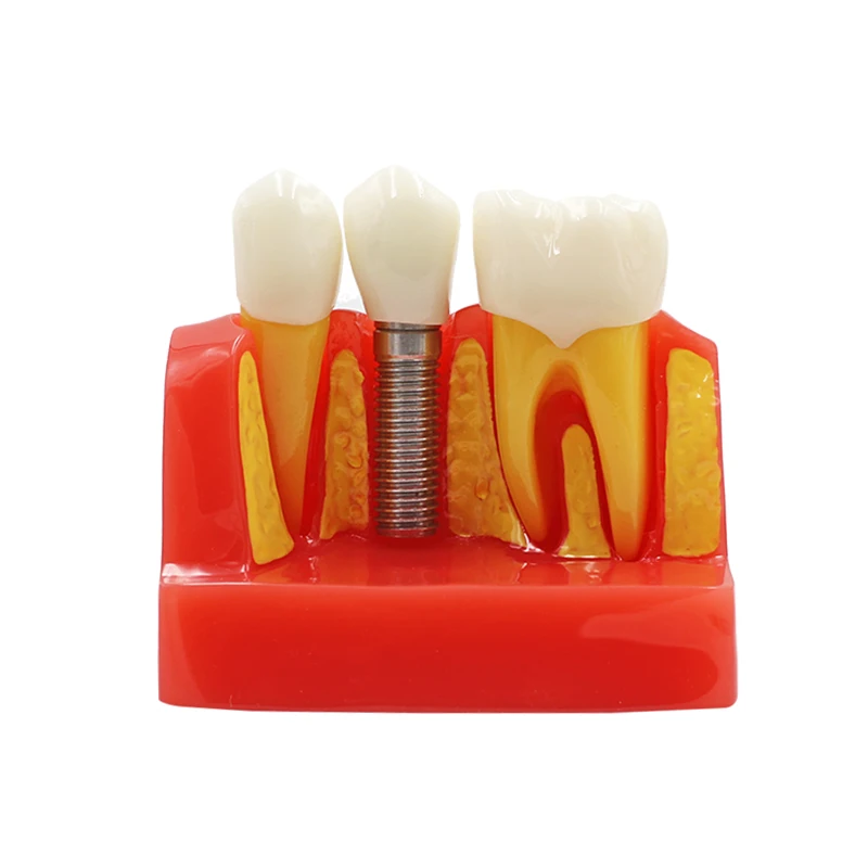  Dental Teach Implant Analysis Crown Bridge Removable Model Dental Teeth Model Teaching study Dentis - 33007211978