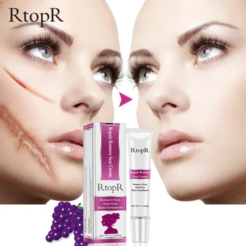 

RtopR Acne Scar Stretch Marks Remover Skin Repair Face Spots Treatment Blackhead Whitening Cream Care