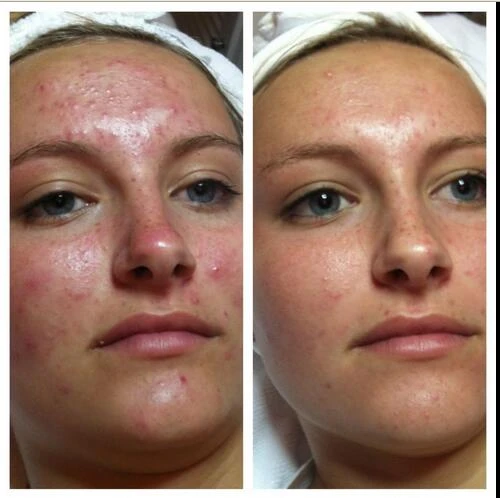 adapalene retinoid cream