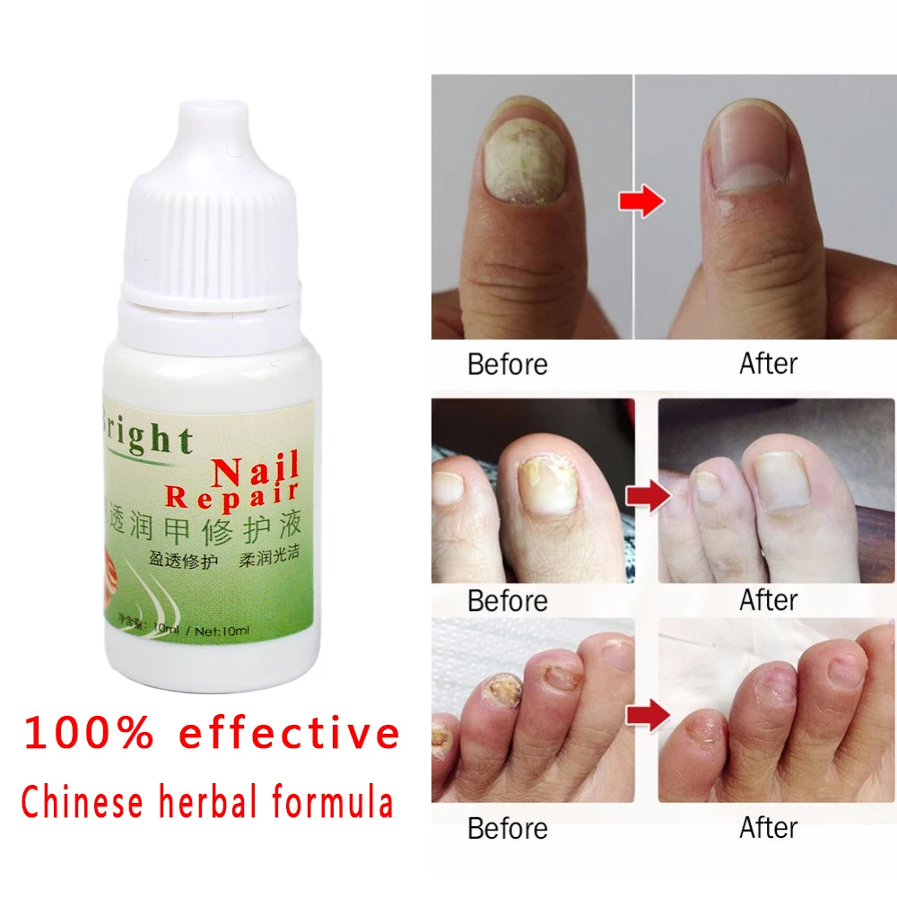 

100% Really WORK Chinese Medicine Plaster Nail Fungus Treatment Cream Kills 99.9% Bacteria and Fungus Nail Onychomycosis Anti