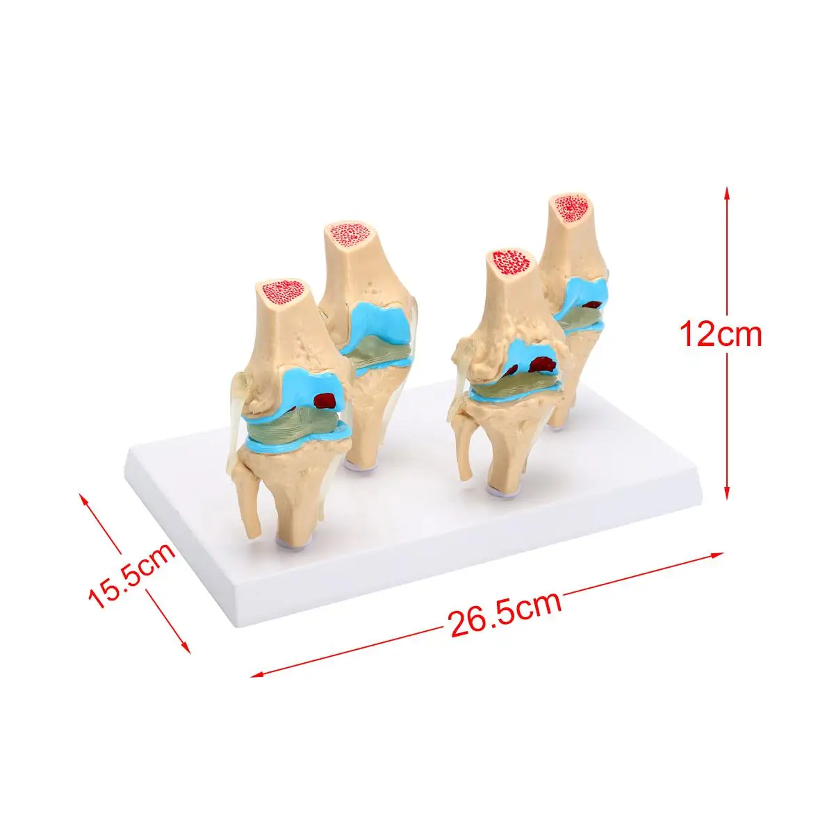 1 компл. Съемный скелет человека коленный сустав анатомия модель остеопороз патологический состояние модели медицинские Наука Обучающие принадлежности