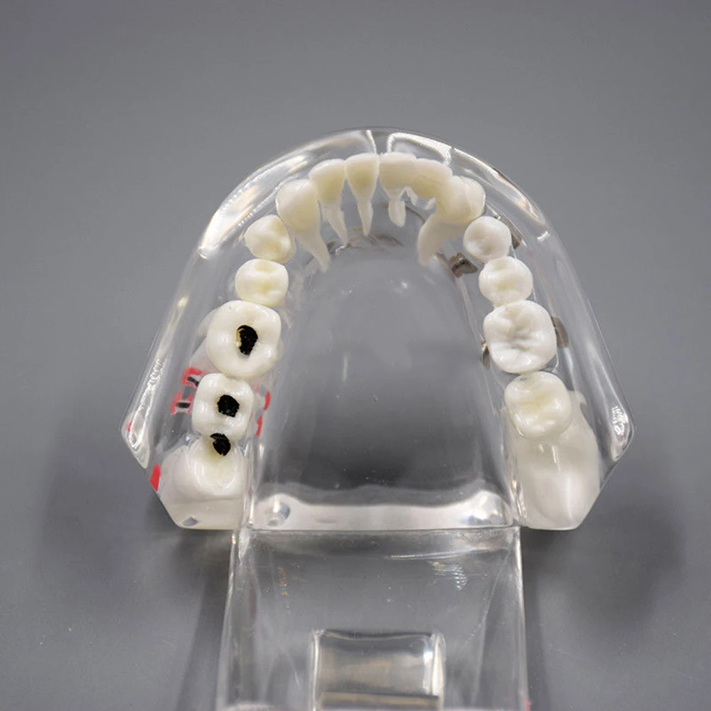  Dental Implant Disease Teeth Model With Restoration Bridge Tooth Dentist For Medical Science Dental - 33007186316