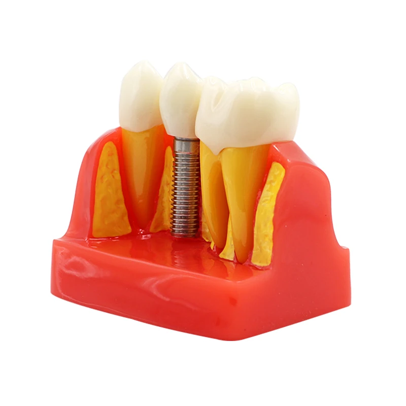  Dental Teach Implant Analysis Crown Bridge Removable Model Dental Teeth Model Teaching study Dentis - 33007211978