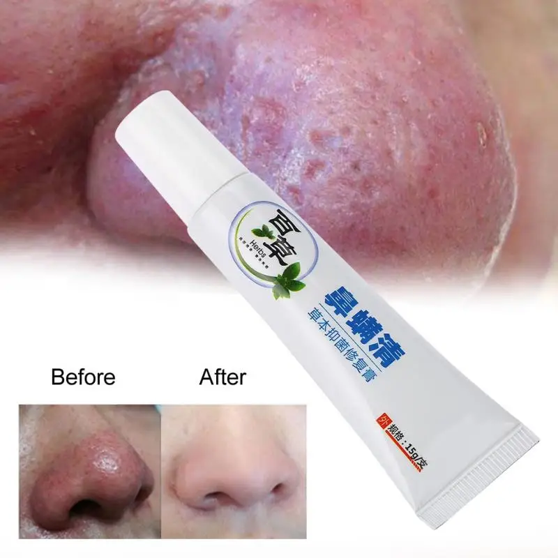 

15g Rosacea Treatment Cream Nose Redness Removal Cleaning Antibacterial Gel Skin Care Product Nose Cleaning Cream