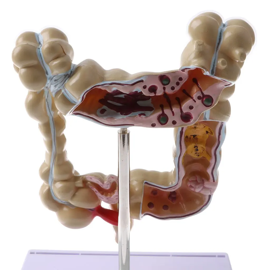  1: 2 Human Large Bowel Pathological Model Medical Anatomical Model for School Teaching Tool Learnin - 32973576715