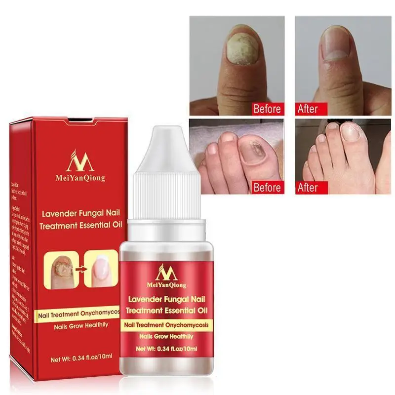 

Nails Chinese Cream Finger Toe Protector Skin Care Fungus Treatment Herb Health Tools Onychomycosis Paronychia Infection C3