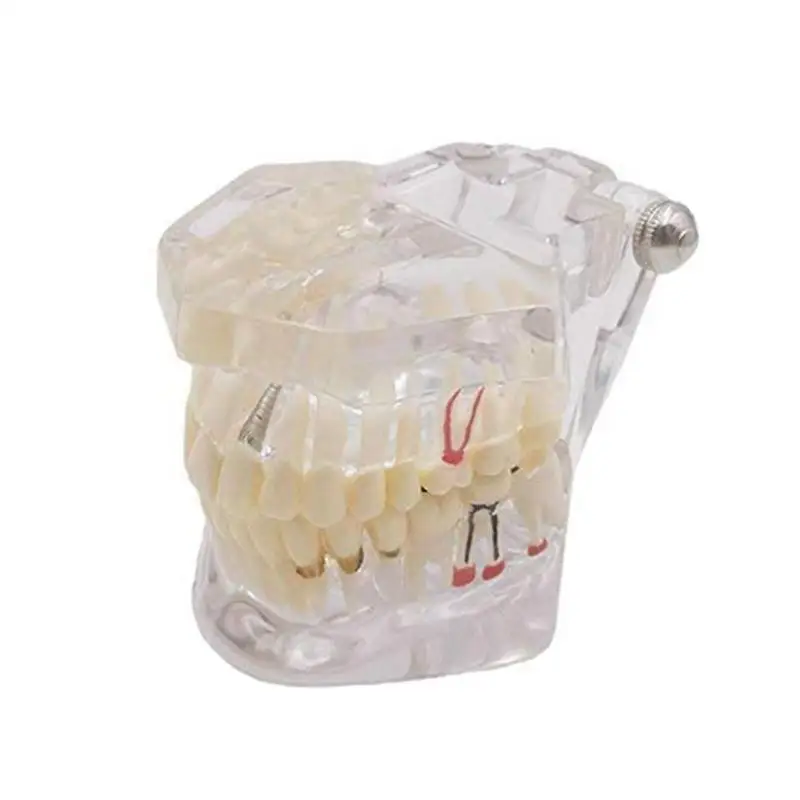 Зубная гигиена полости рта имплантат для лечения зубов Модель для медицинского обучения ПВХ/Смола уход за полостью рта Отбеливание зубов Модель зубов
