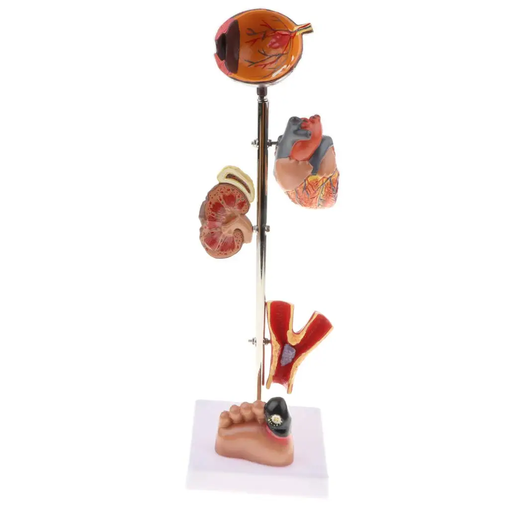

Diabetes Pathological Model 5 Removable Parts Human Anatomical Model for School Teaching Tool Learning Display Lab Supplies